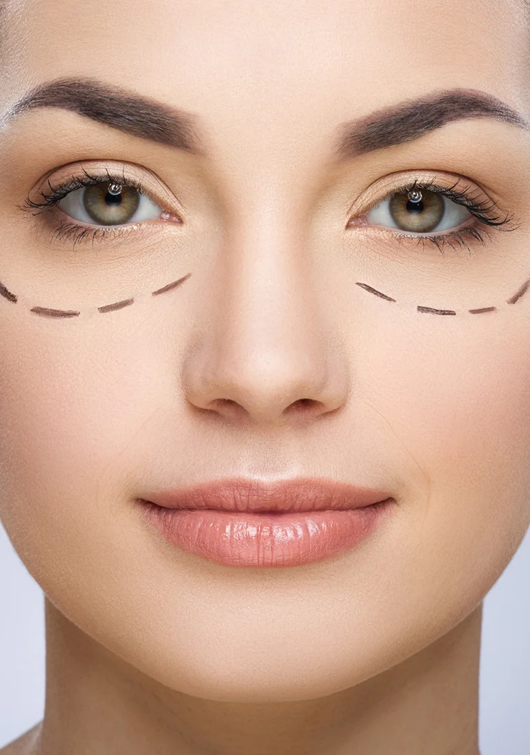 plastic surgery a day - #BICHECTOMY. What are Bichat bags and Bichectomy?  Bichat balls or bags are clusters of fat that are located below the  cheekbones and that give support and structure
